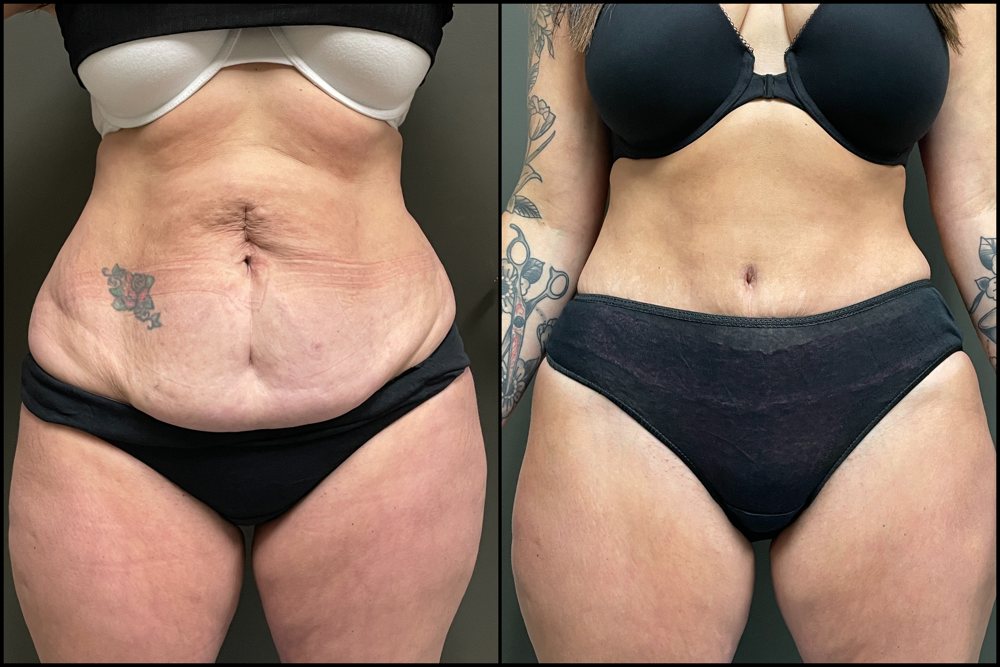 Abdominoplasty with Lipo Assist - 44 Years Old