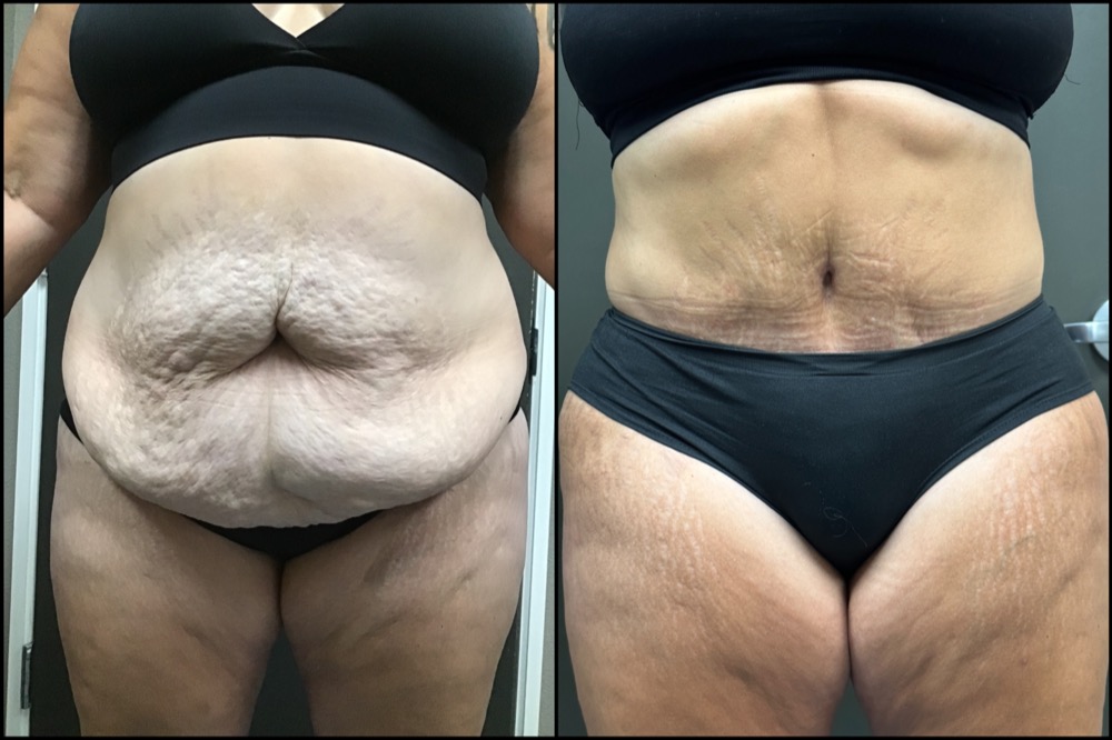 Abdominoplasty - 51 Years Old