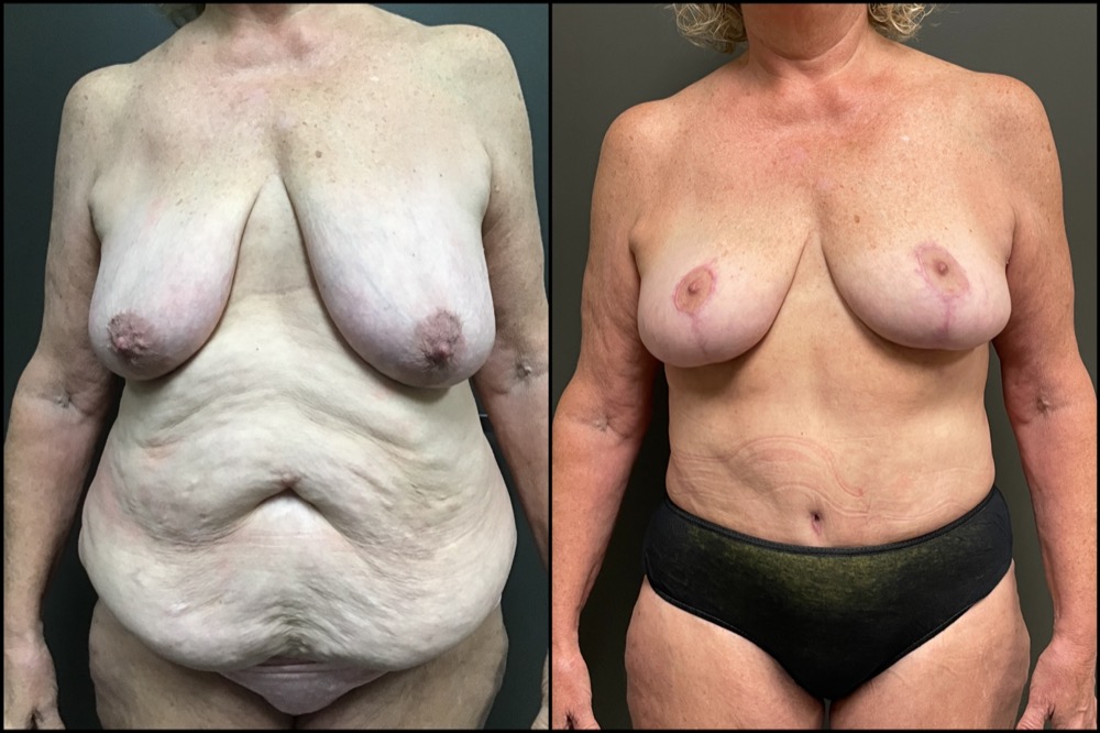 Abdominoplasty & Breast Lift - 59 Years Old