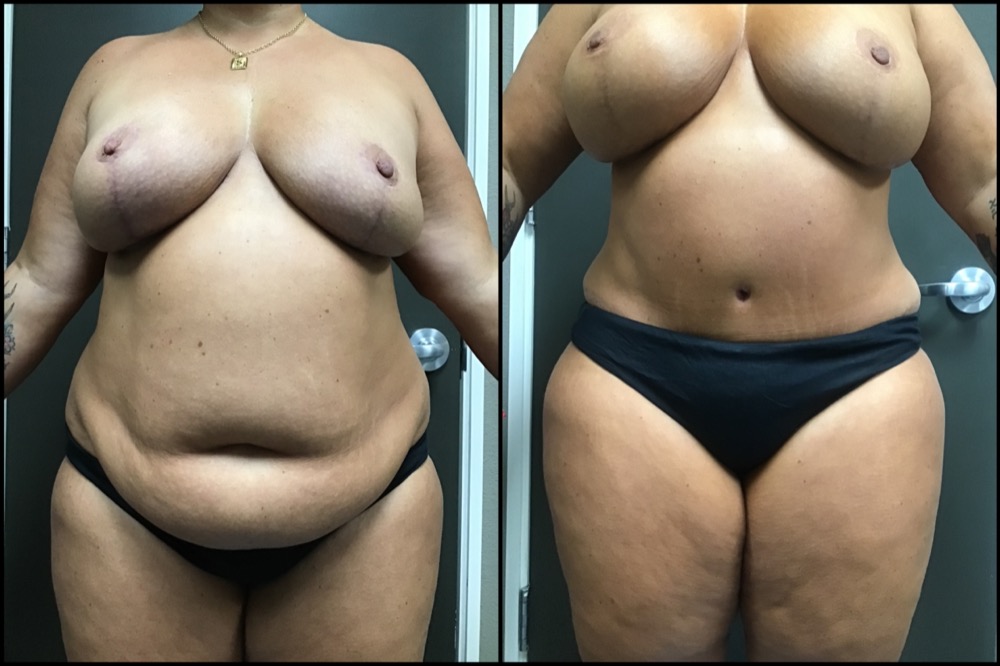 Abdominoplasty & Breast Augmentation with Lift - 42 Years Old