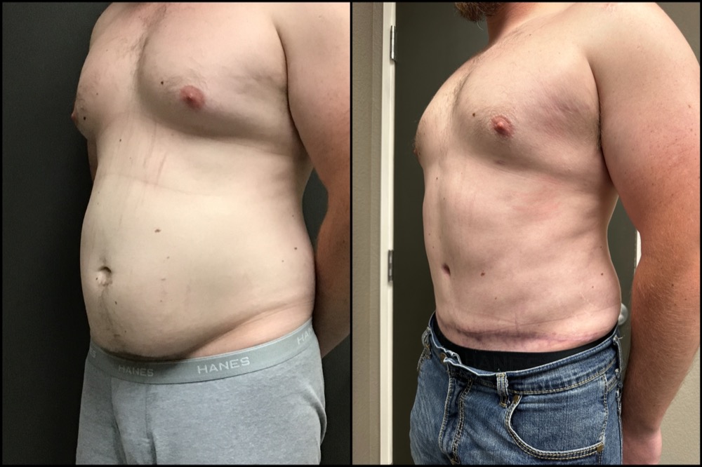 Abdominoplasty & Gynecomastia - 29 Years Old