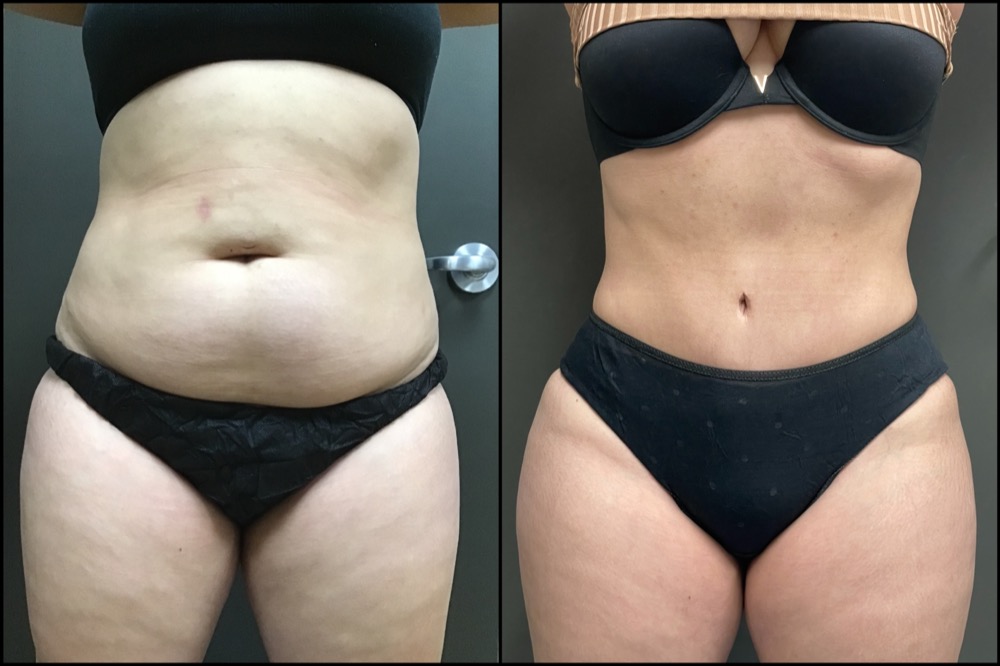 Abdominoplasty - 30 Years Old
