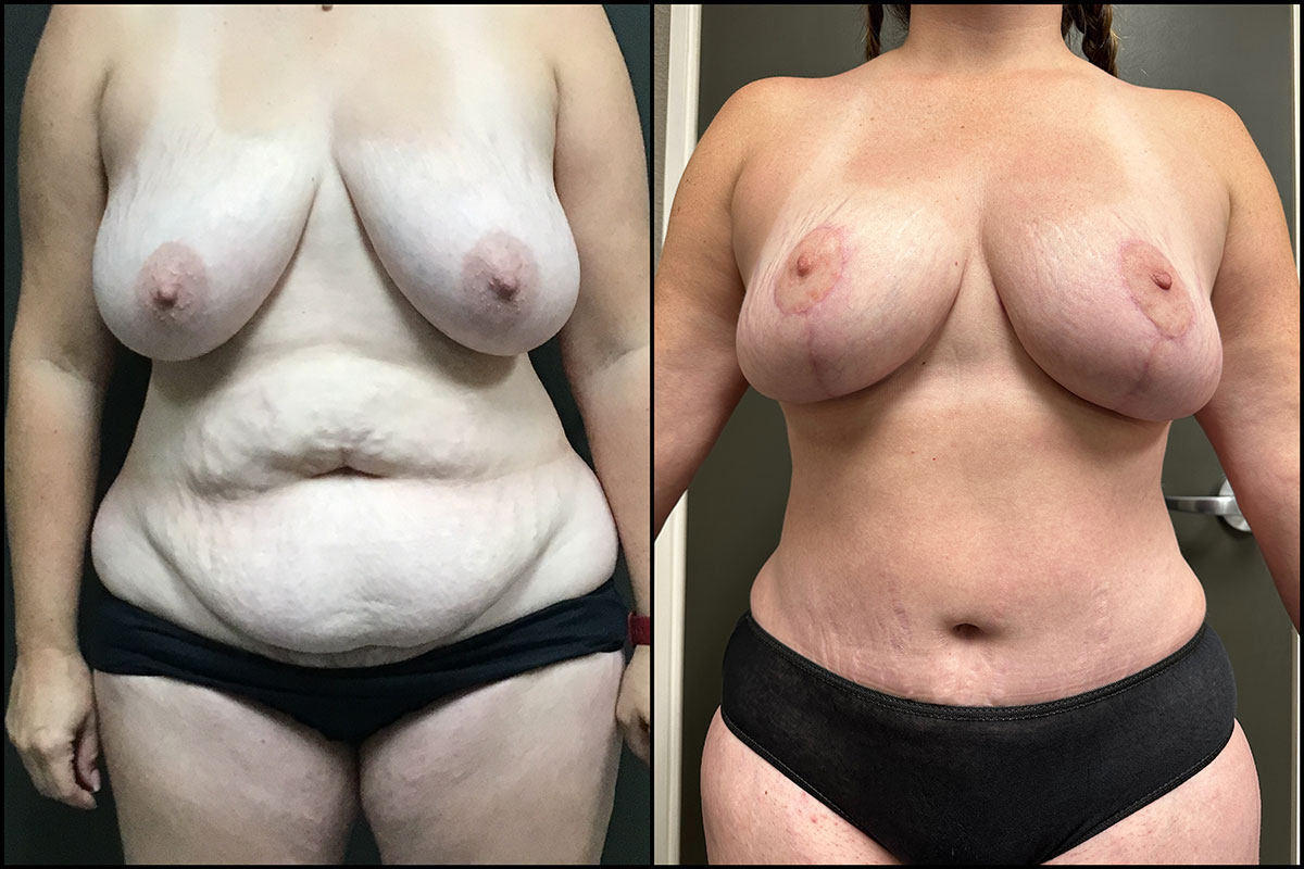 Abdominoplasty & Breast Reduction/ Lift – 40 Years Old – 5’3 and 166lbs #1