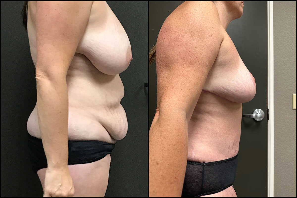 Abdominoplasty & Breast Reduction/ Lift – 40 Years Old – 5’3 and 166lbs #2