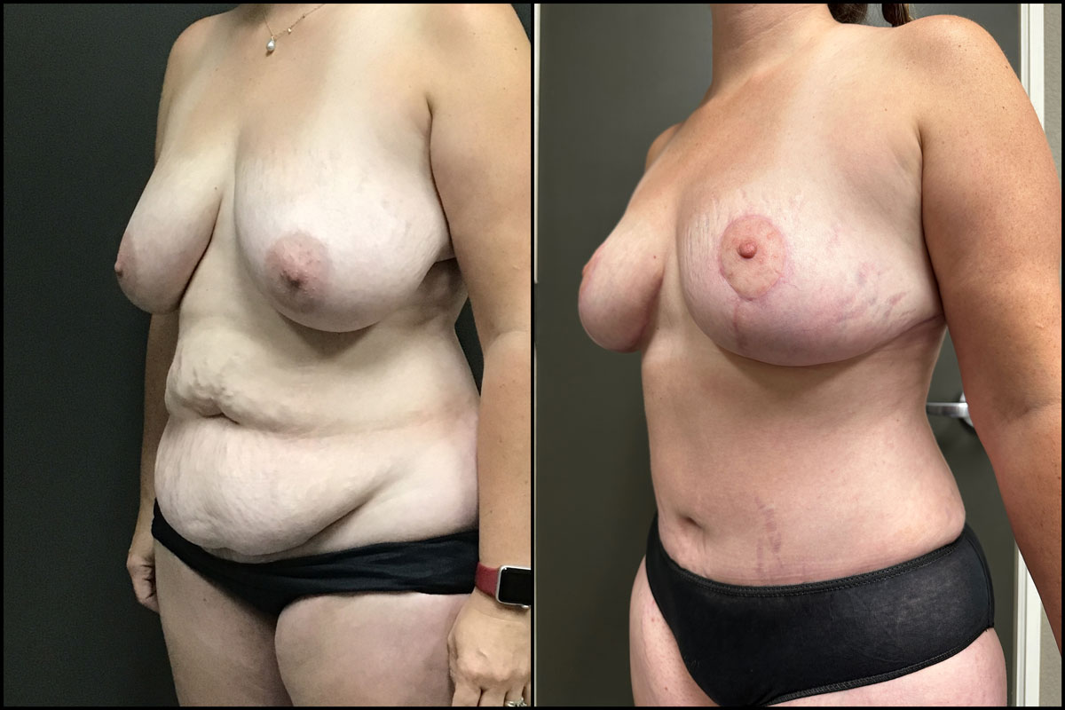 Abdominoplasty & Breast Reduction/ Lift – 40 Years Old – 5’3 and 166lbs #3
