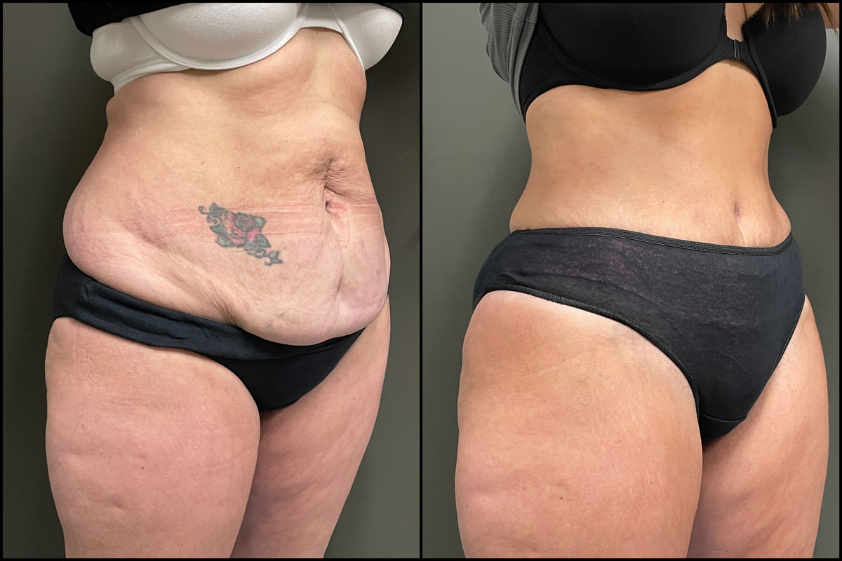 Abdominoplasty with Lipo Assist – 44 Years Old – 5’6 and 160lbs