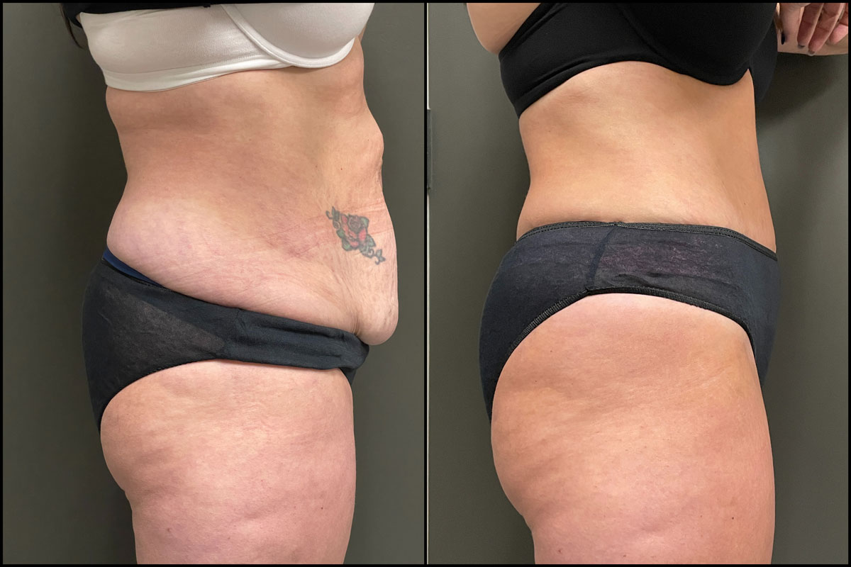Abdominoplasty with Lipo Assist – 44 Years Old – 5’6 and 160lbs #2
