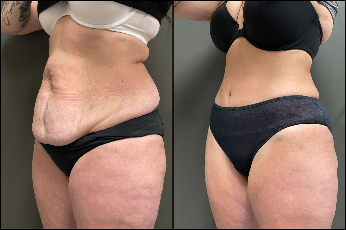 Abdominoplasty with Lipo Assist – 44 Years Old – 5’6 and 160lbs #3