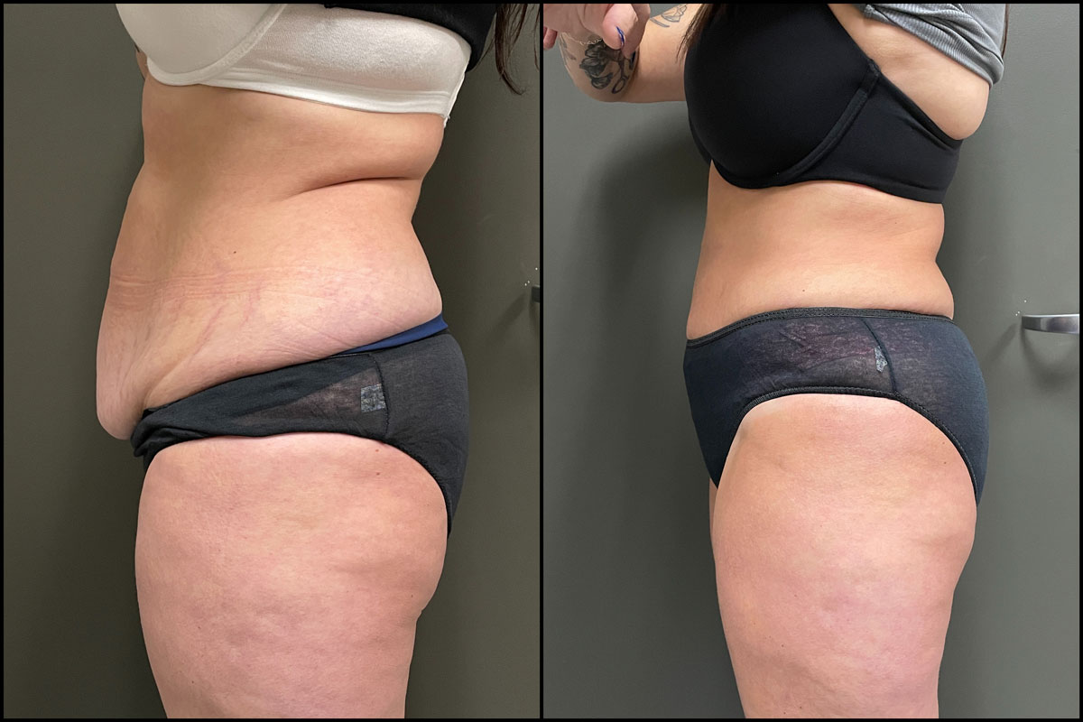 Abdominoplasty with Lipo Assist – 44 Years Old – 5’6 and 160lbs #4