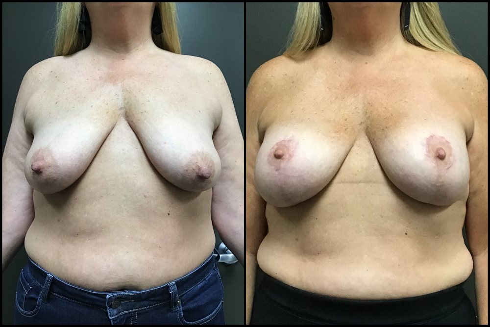 Breast Augmentation & Lift - 425cc Silicone Implant - 48 Years Old