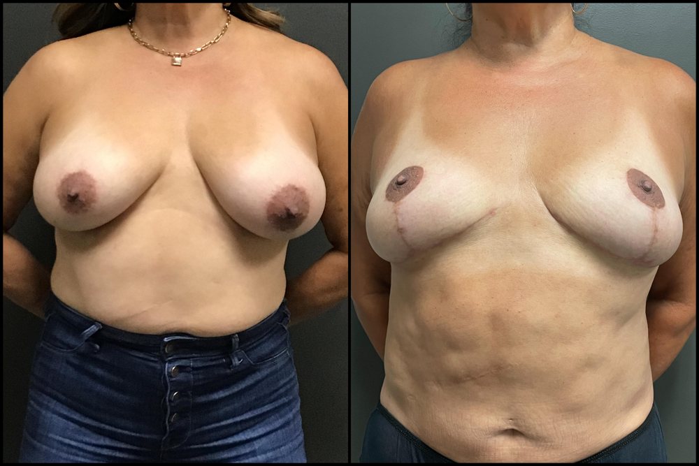 Breast Reduction - DD cup to C cup - 56 Years Old 