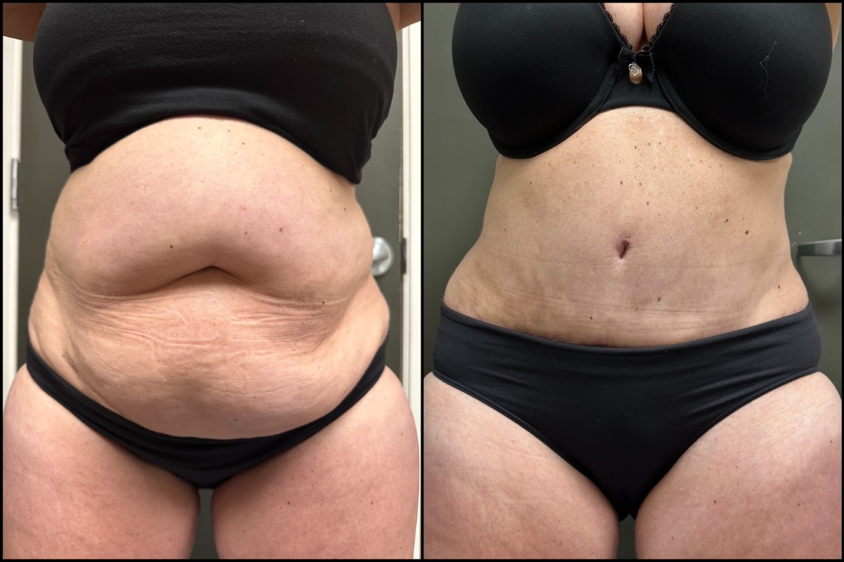 Abdominoplasty - 57 Years Old - 5'1 and 144lbs 1