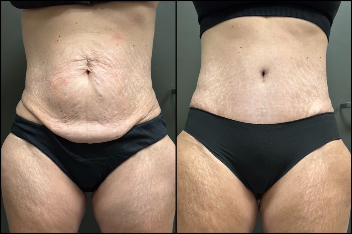 Abdominoplasty - 51 Years Old - 5'4 and 135lbs 1