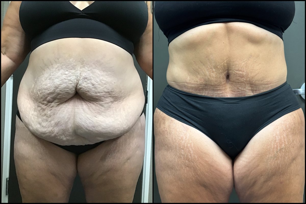Abdominoplasty – 51 Years Old – 5’6 and 245lbs #1