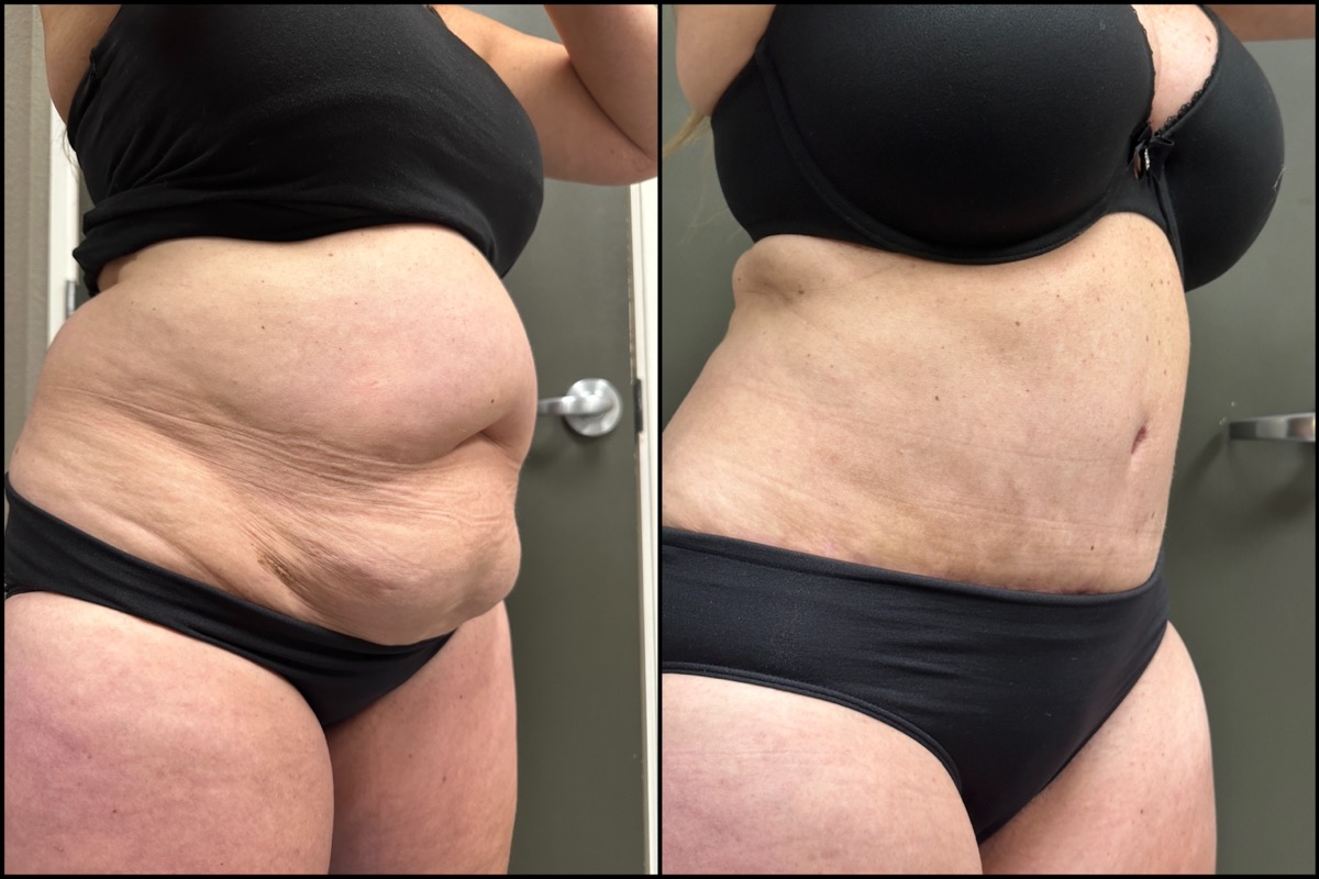 Abdominoplasty - 57 Years Old - 5'1 and 144lbs 2