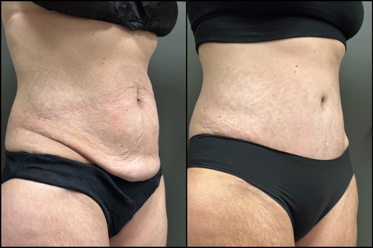 Abdominoplasty - 51 Years Old - 5'4 and 135lbs 2