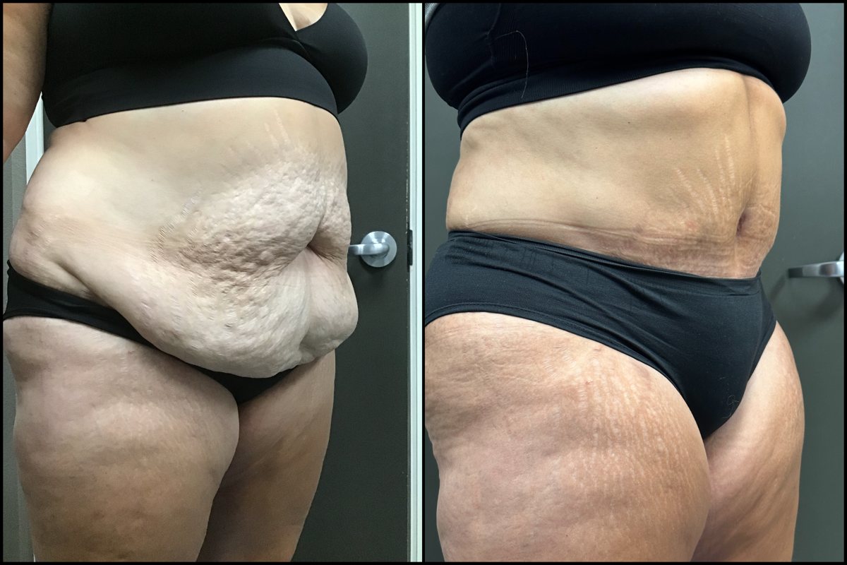 Abdominoplasty – 51 Years Old – 5’6 and 245lbs #2
