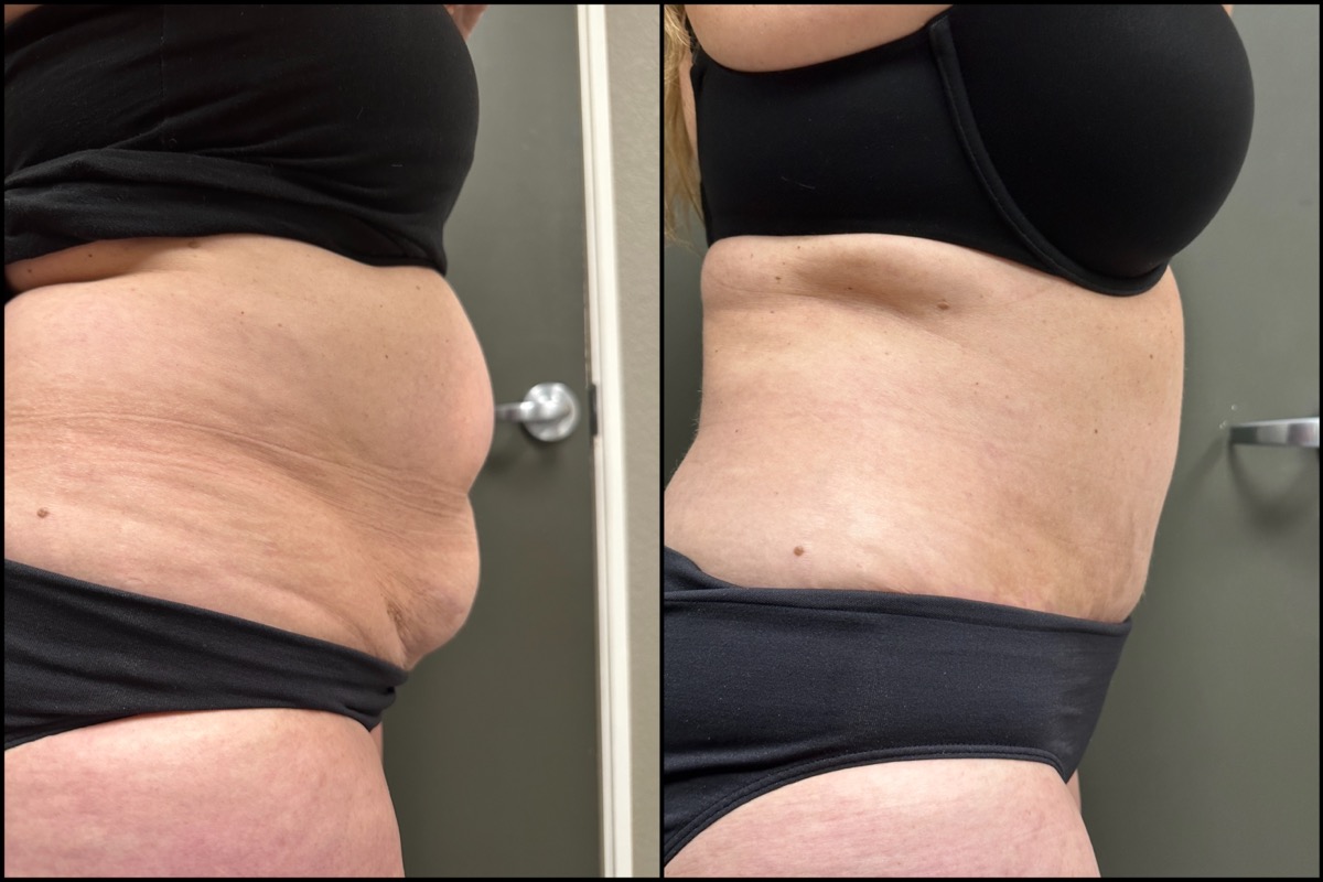 Abdominoplasty - 57 Years Old - 5'1 and 144lbs 3