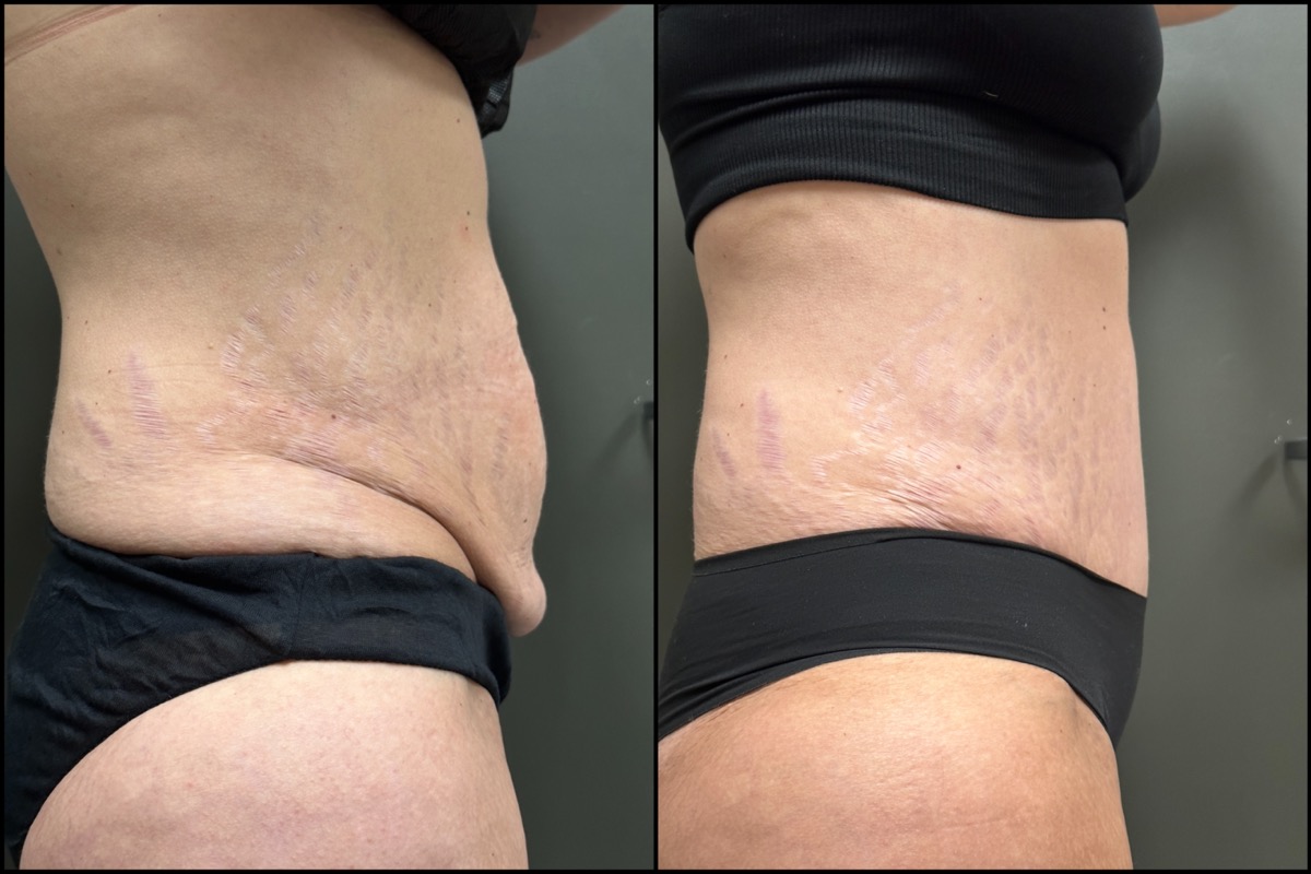 Abdominoplasty - 51 Years Old - 5'4 and 135lbs 3