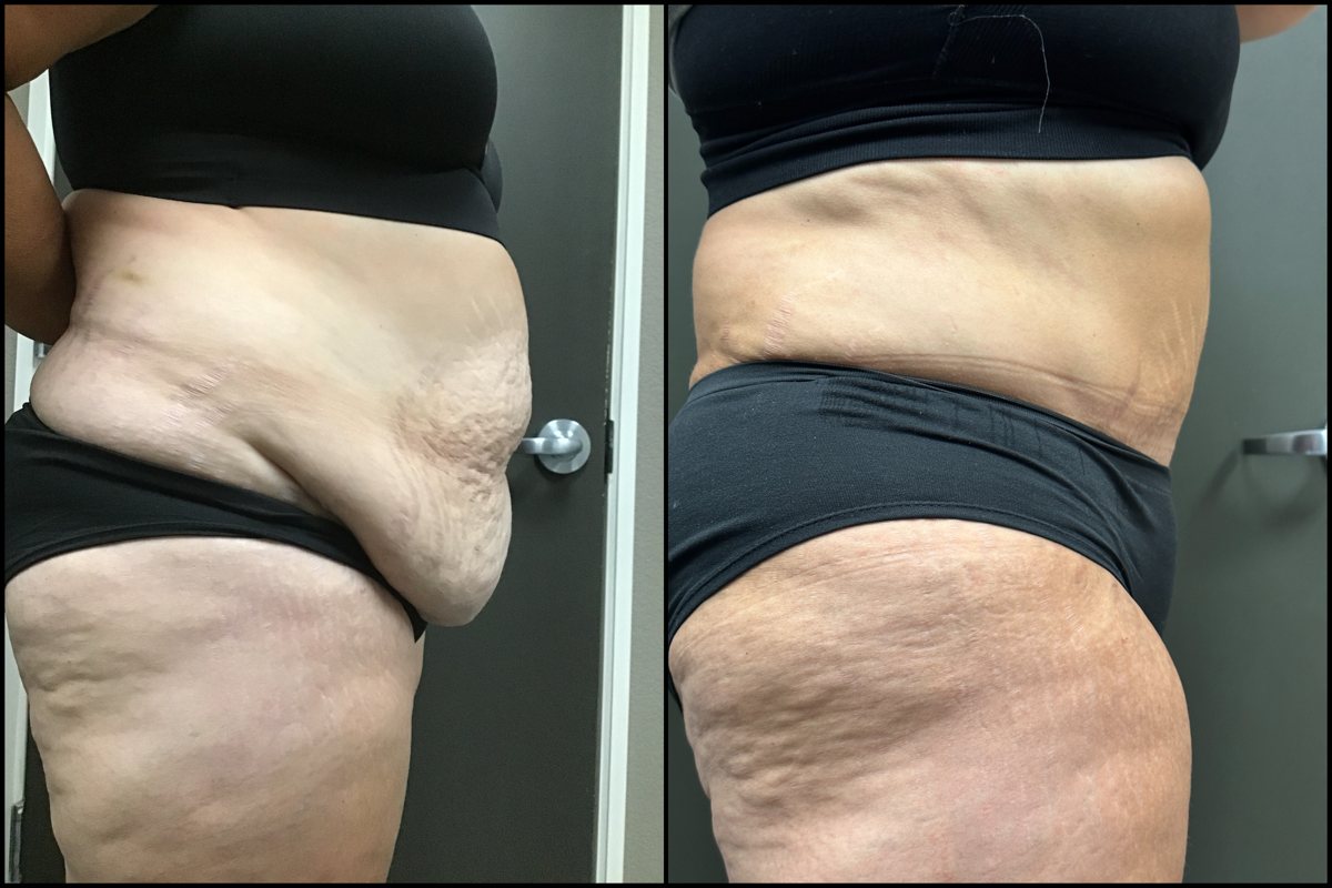 Abdominoplasty – 51 Years Old – 5’6 and 245lbs