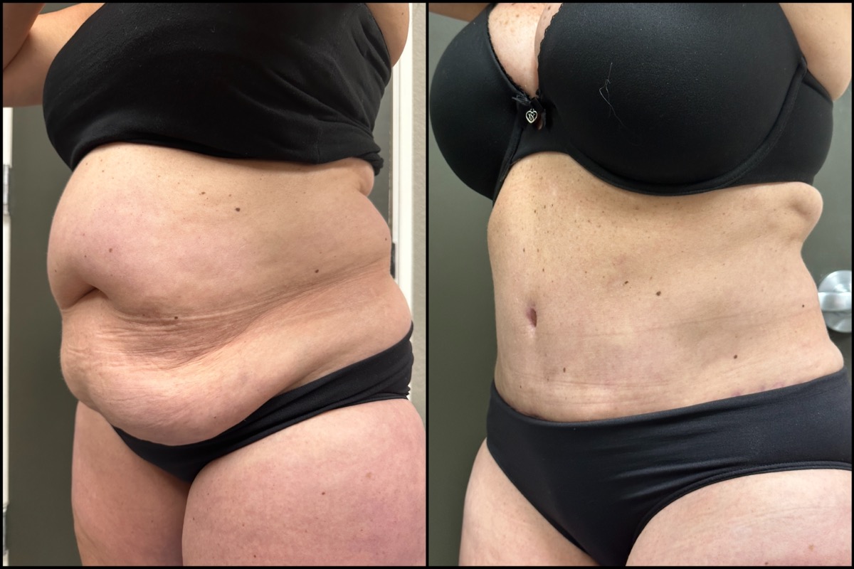 Abdominoplasty - 57 Years Old - 5'1 and 144lbs 4