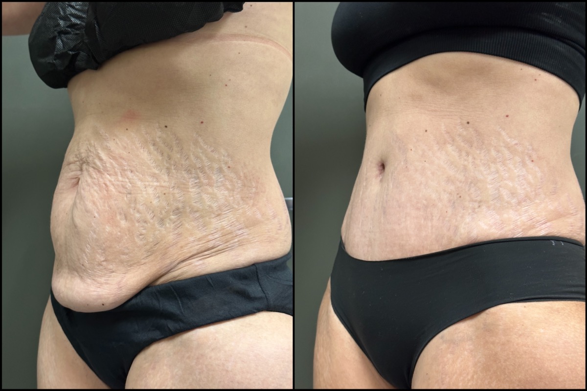 Abdominoplasty - 51 Years Old - 5'4 and 135lbs 4