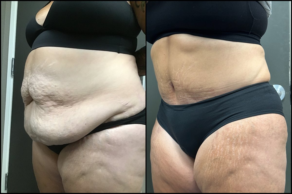 Abdominoplasty – 51 Years Old – 5’6 and 245lbs