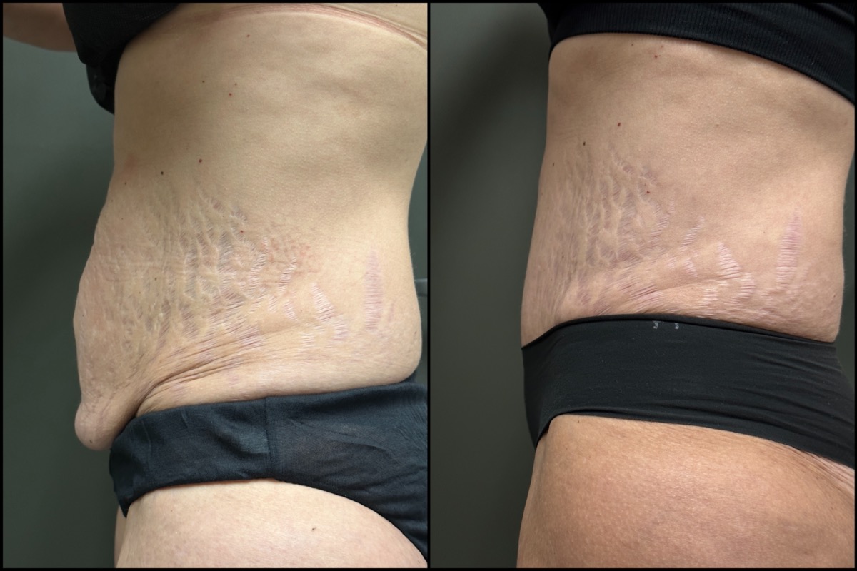Abdominoplasty - 51 Years Old - 5'4 and 135lbs 5