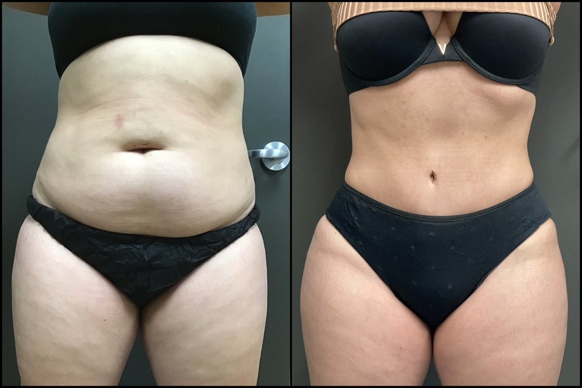 Abdominoplasty - 30 Years Old - 5'1 and 145lbs #1