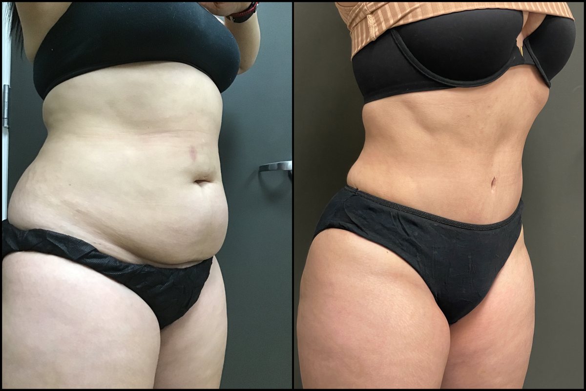 Abdominoplasty - 30 Years Old - 5'1 and 145lbs #2