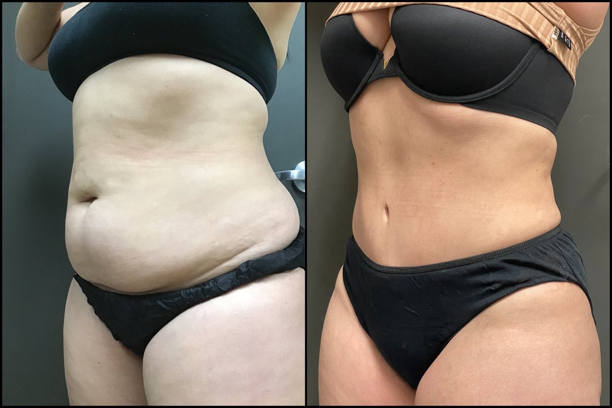Abdominoplasty - 30 Years Old - 5'1 and 145lbs #3