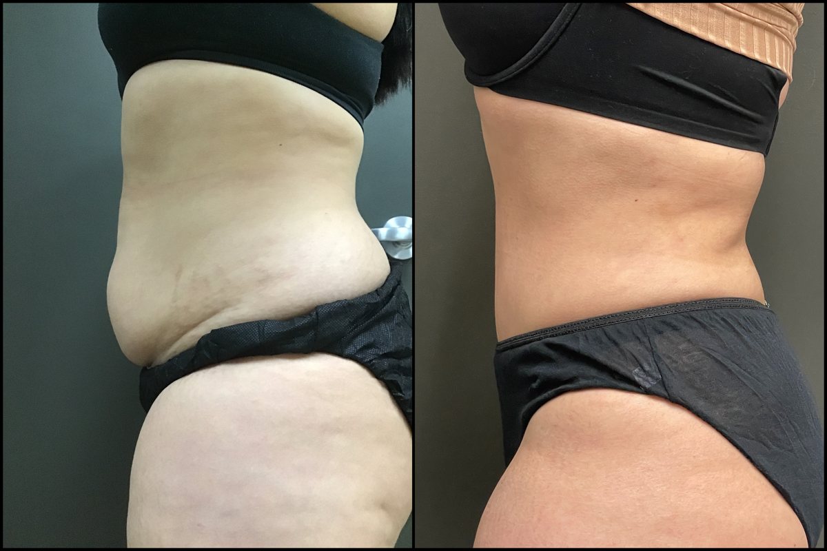 Abdominoplasty - 30 Years Old - 5'1 and 145lbs #4