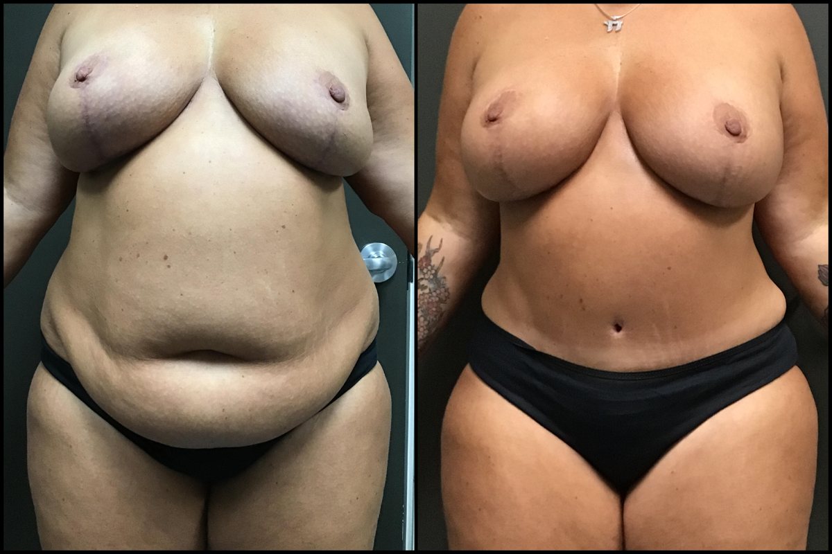 Abdominoplasty & Breast Augmentation with Lift - 42 Years Old - 5'4 and 241lbs #1