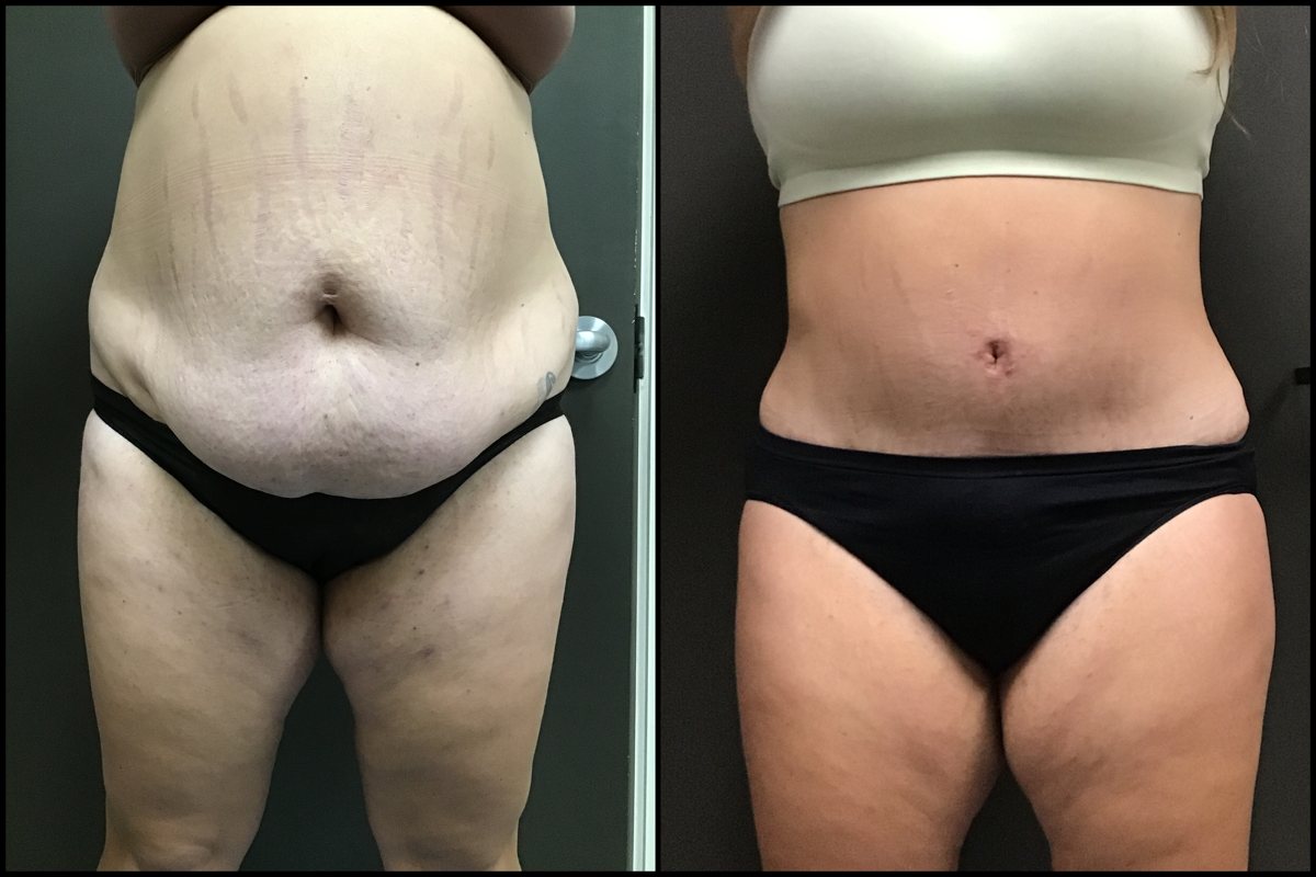 Abdominoplasty – 30 Years Old – 5’7 and 220lbs 1