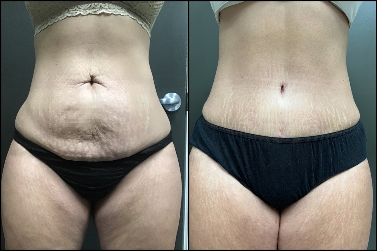 Abdominoplasty - 40 Years Old - 5'3 and 155lbs 1