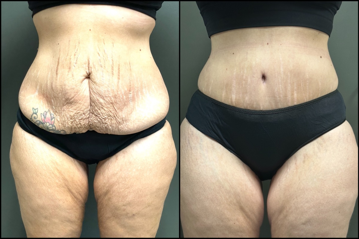 Abdominoplasty - 38 Years Old - 5'4 and 158lbs 1