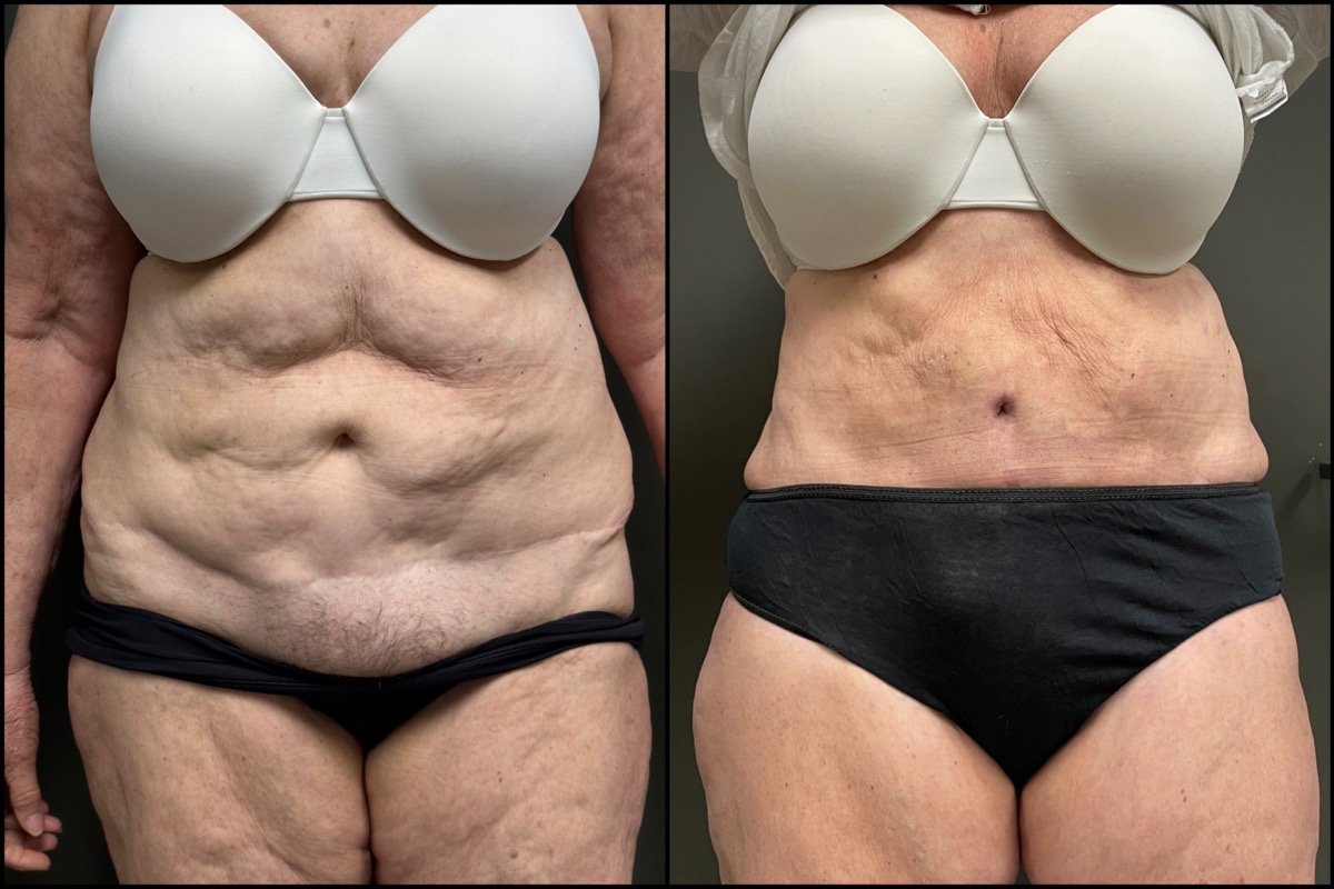 Abdominoplasty - 70 Years Old - 5'8 and 178lbs 1