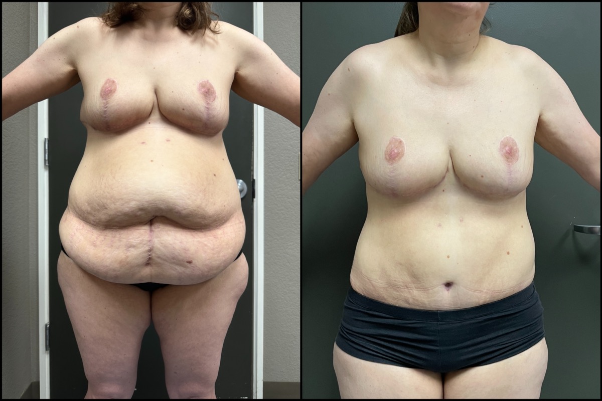 Abdominoplasty & Thigh Liposuction - 45 Years Old - 5'3 and 165lbs 1