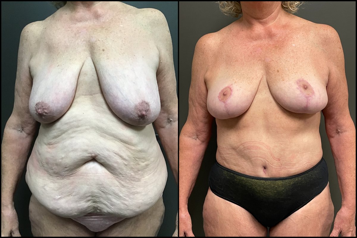 Abdominoplasty & Breast Lift – 59 Years Old – 5’4 and 165lbs #1