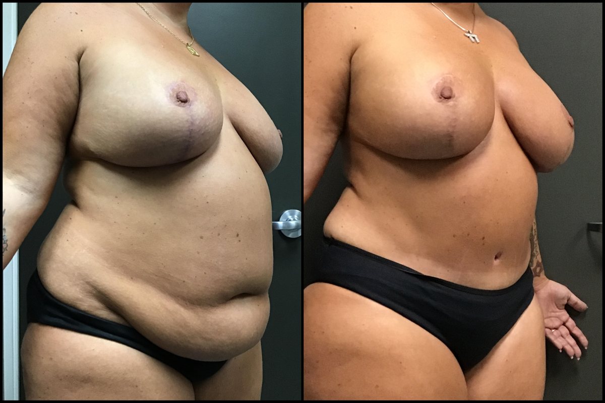 Abdominoplasty & Breast Augmentation with Lift - 42 Years Old - 5'4 and 241lbs #5