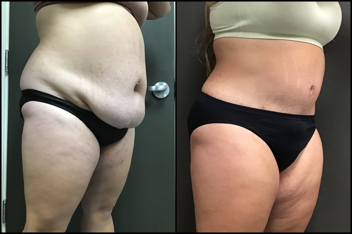 Abdominoplasty – 30 Years Old – 5’7 and 220lbs 2