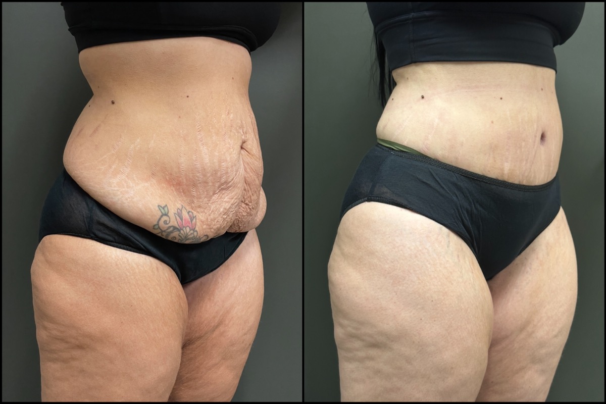 Abdominoplasty - 38 Years Old - 5'4 and 158lbs 2