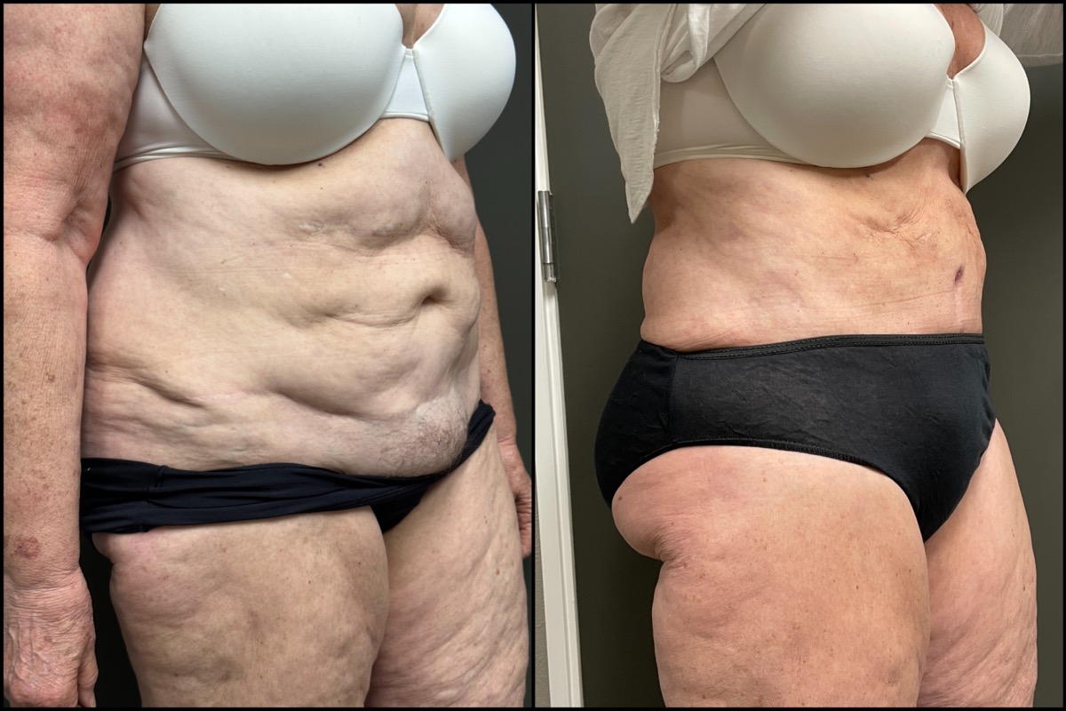 Abdominoplasty - 70 Years Old - 5'8 and 178lbs 2