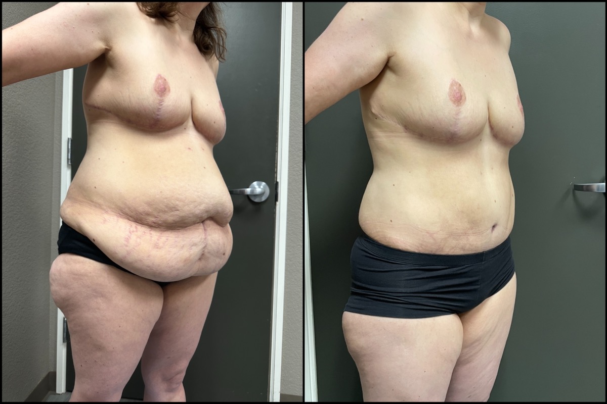 Abdominoplasty & Thigh Liposuction - 45 Years Old - 5'3 and 165lbs 2