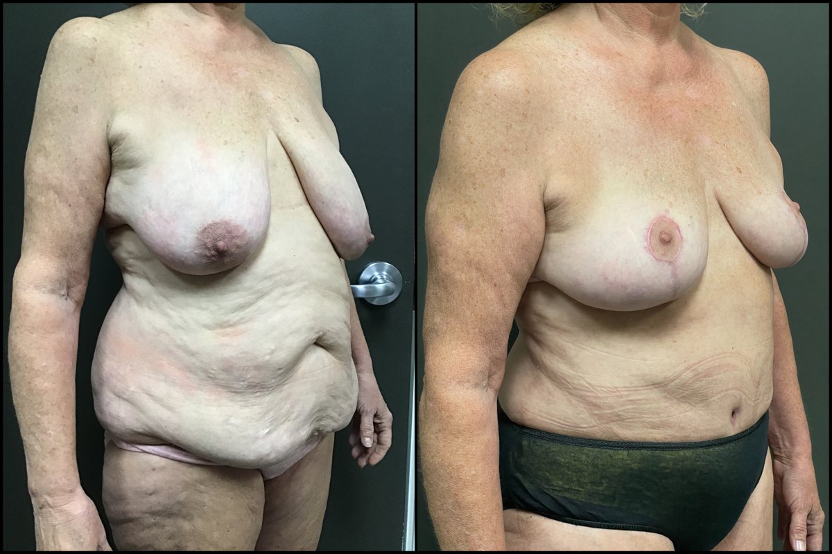 Abdominoplasty & Breast Lift – 59 Years Old – 5’4 and 165lbs #2