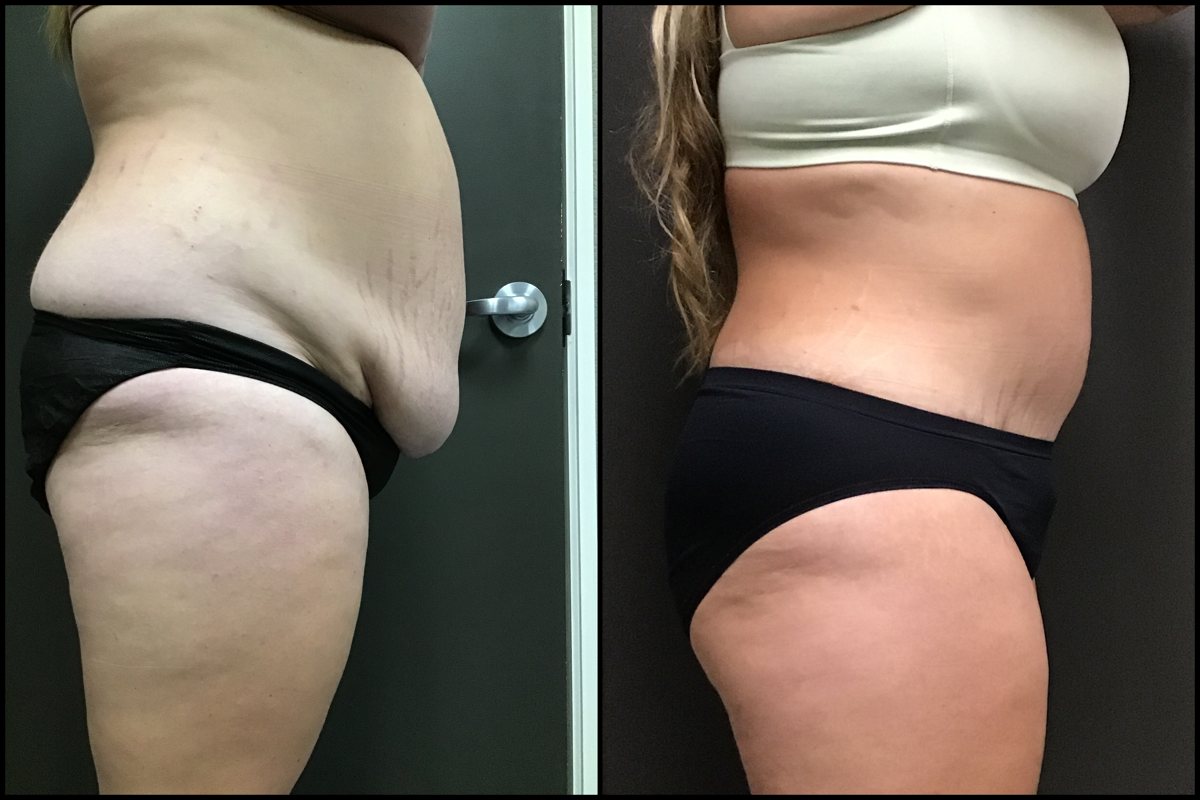 Abdominoplasty – 30 Years Old – 5’7 and 220lbs 3