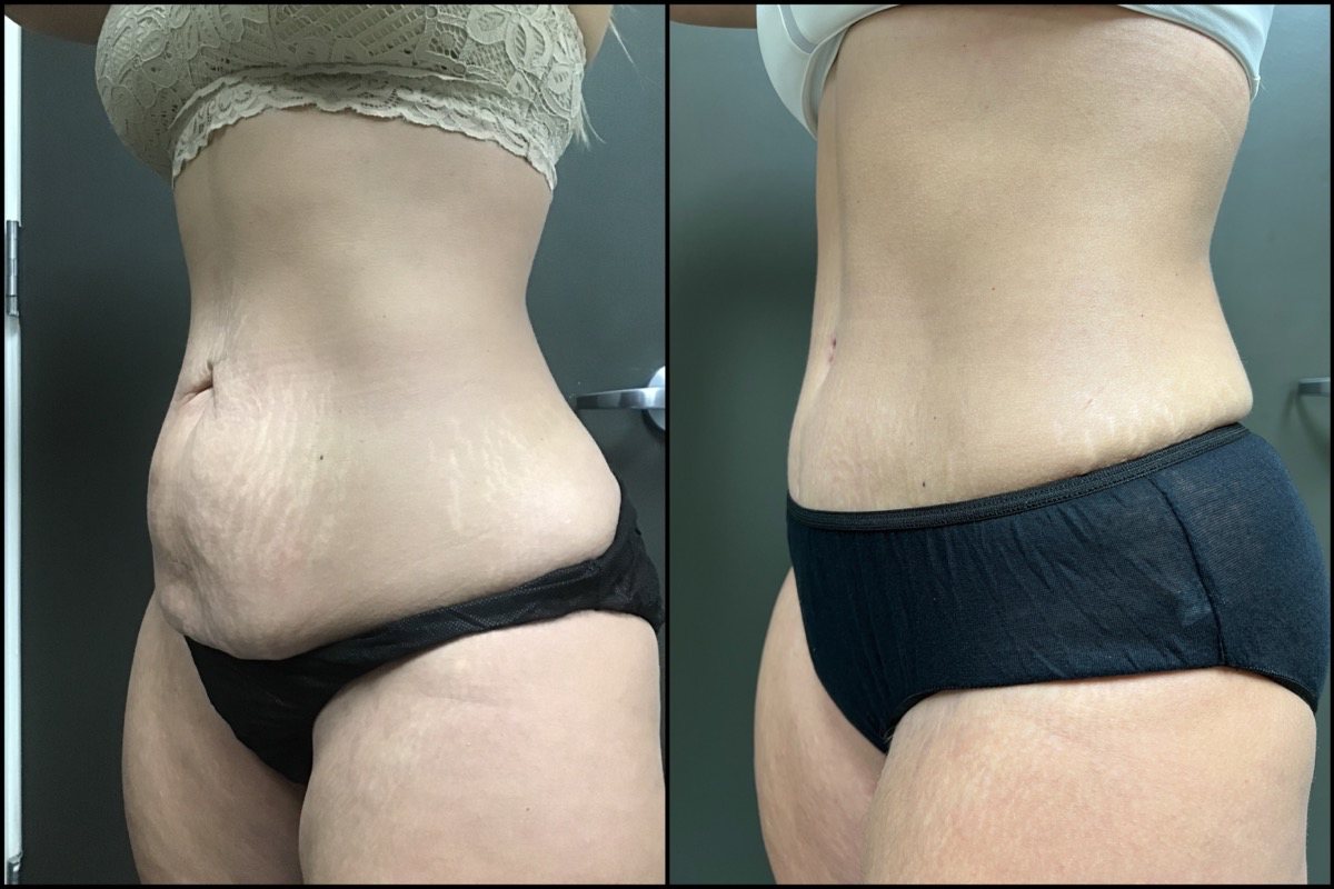 Abdominoplasty - 40 Years Old - 5'3 and 155lbs 3