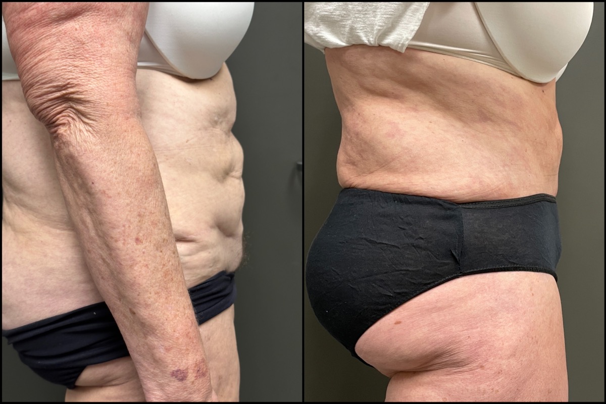 Abdominoplasty - 70 Years Old - 5'8 and 178lbs 3