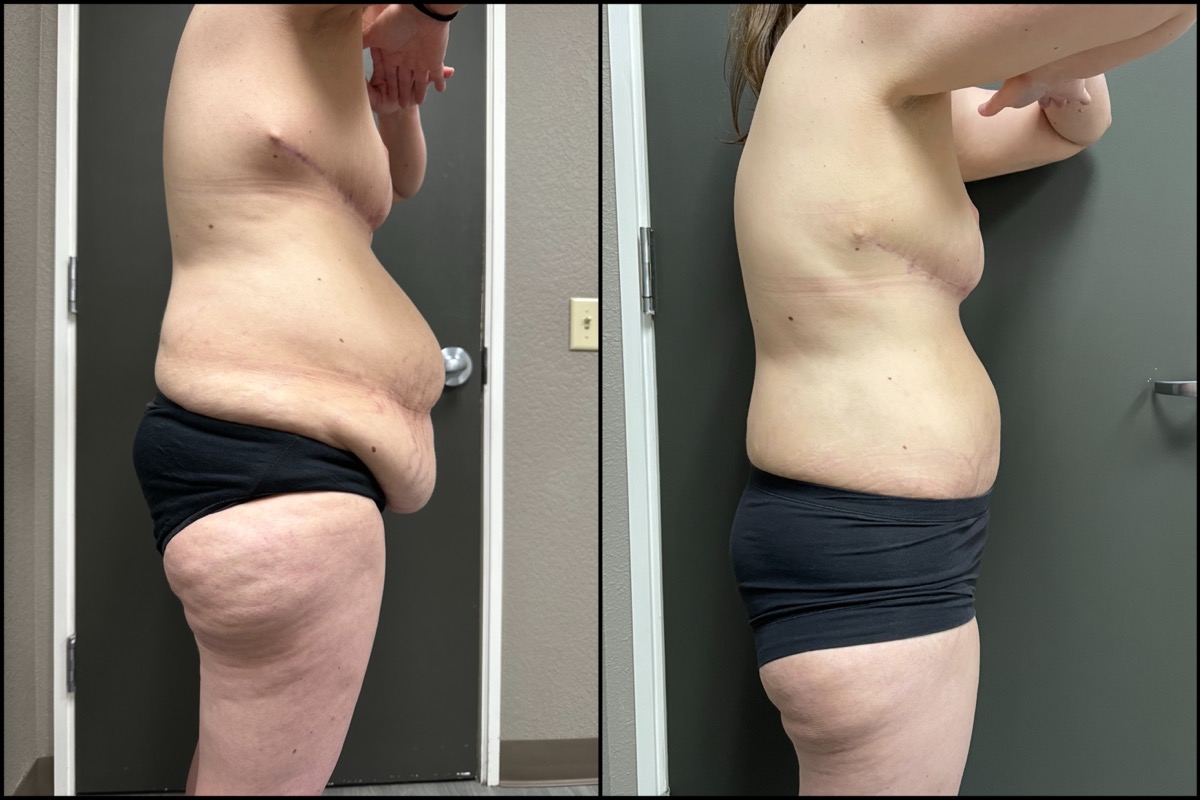Abdominoplasty & Thigh Liposuction - 45 Years Old - 5'3 and 165lbs 3