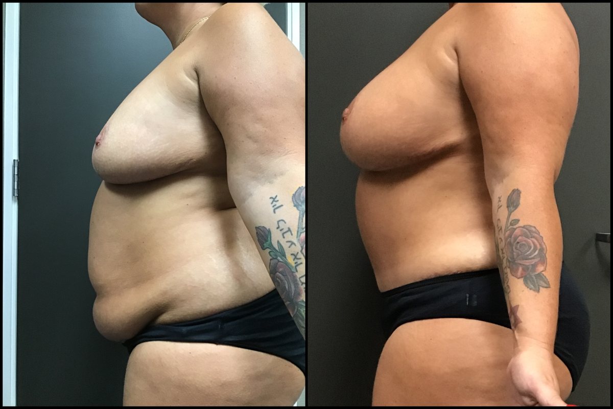 Abdominoplasty & Breast Augmentation with Lift - 42 Years Old - 5'4 and 241lbs #3
